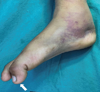 Clinical photograph after spinal anaesthesia showing persistent acute flexion of interphalangeal joint of the right great toe (arrow).